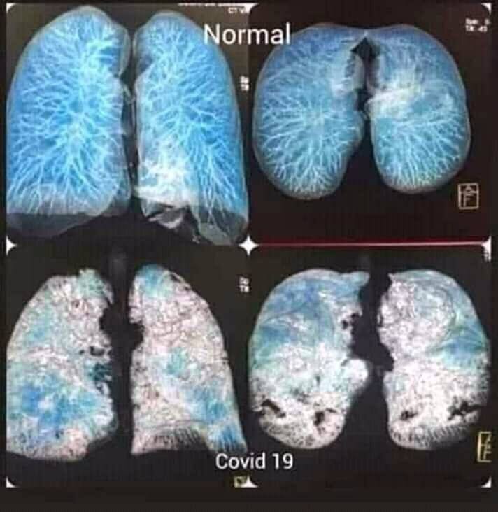 Украинские врачи показали фото легких больного COVID-19: разница поражает