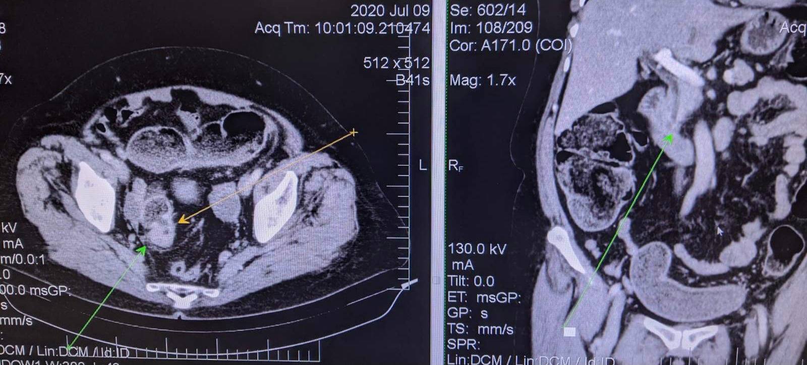 Українські лікарі врятували жінку з незвичайним діагнозом: таких випадків одиниці