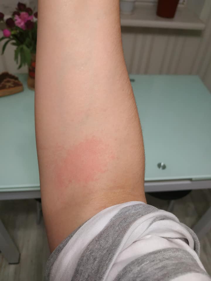 Еще и охотятся! Украинскую поэтессу укусил опасный паук (фото)