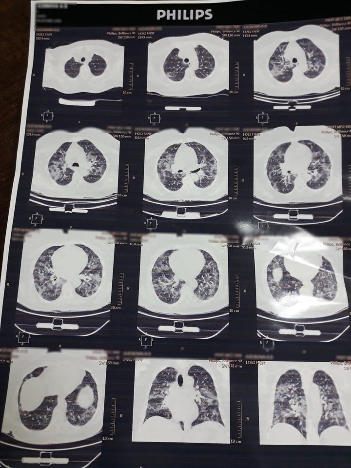 Возможен отек легких: врач показал снимки больного с коронавирусом после антибиотиков