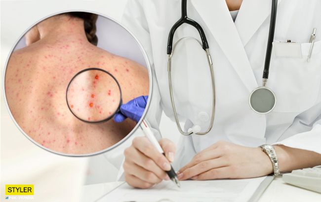 Може постраждати мозок дитини: лікар розповів про жахливі наслідки вітрянки