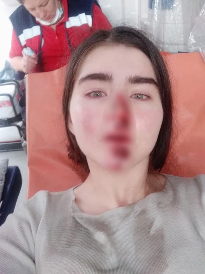 В Киеве девушка взяла на прокат самокат и разбила лицо из-за сломанных тормозов