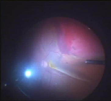 Украинские врачи первыми в мире провели операцию по удалению гигантской опухоли глаза: как это удалось