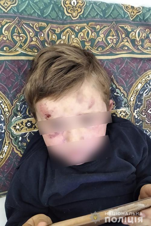 Бил по голове и сломал ногу: под Тернополем отчим избил 4-летнего ребенка