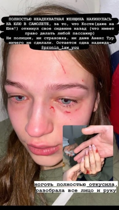 В самолете в Доминикану жестоко избили украинку: расцарапали лицо и откусили ноготь