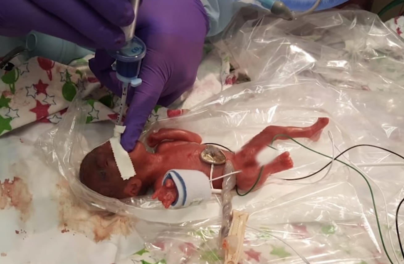 Справжній боєць: дівчинка народилася з вагою 245 грамів і вижила (відео)