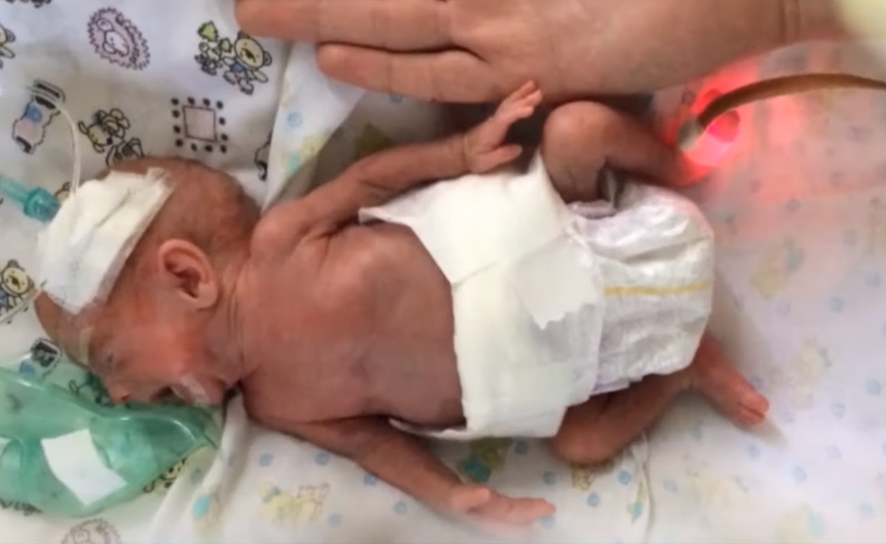 Родители отказались: во Львове впервые выходили ребенка с весом 480 грамм (видео)