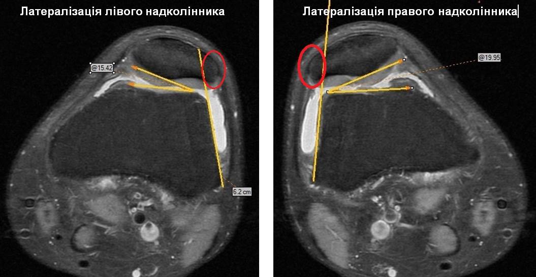 &quot;Пройшов пекло війни і полон в Донецьку&quot;: волонтери просять кошти на лікування героя АТО