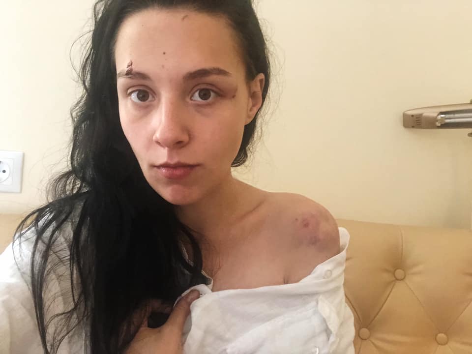 Искусал лицо и плечи: в Киеве журналист жестоко избил экс-возлюбленную (фото)