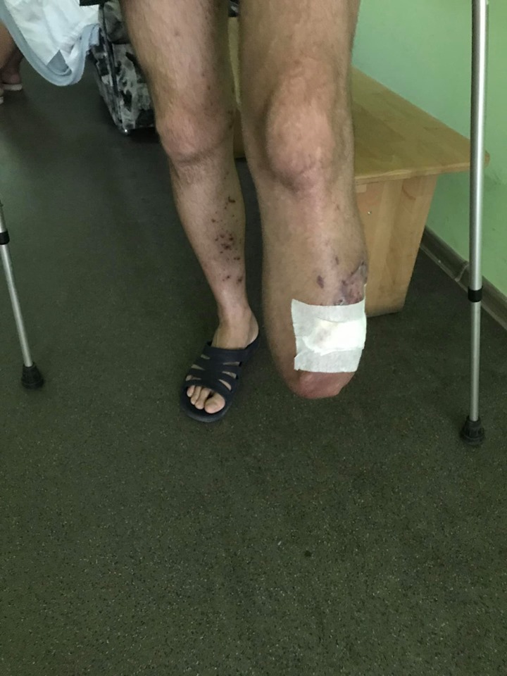 Война продолжается: волонтер просит помочь тяжелораненым бойцам ВСУ