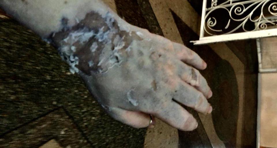 Ты увидела глаза палача: отец Гандзюк показал жуткие фото нападения на дочь