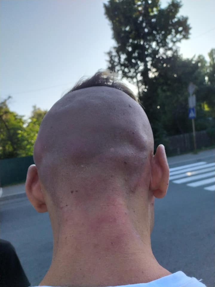 Били руками і ногами: у Чернігові по-звірячому напали на журналіста