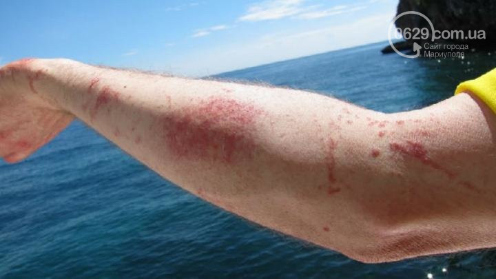 Пляжи Азовского моря атакуют опасные медузы: люди показывают ожоги