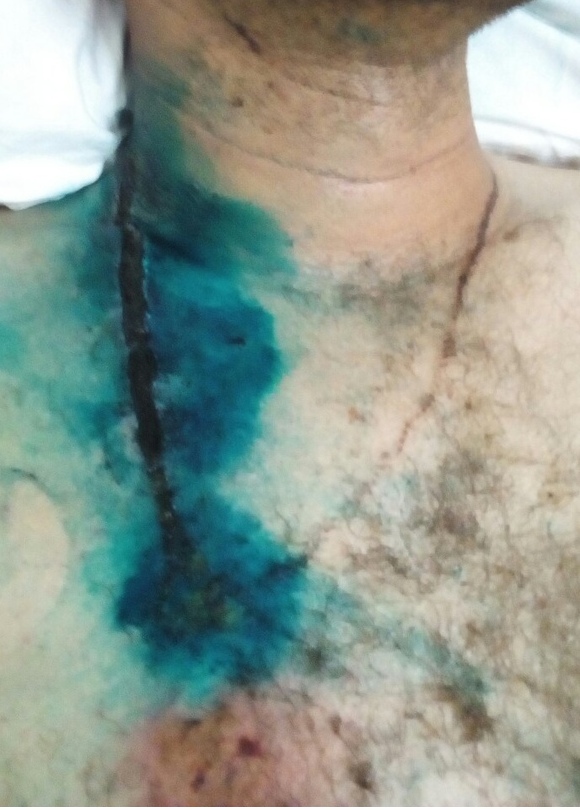 Шах і мат, атеїсти: хрестик врятував чоловіка від смерті при ударі блискавки (фото)