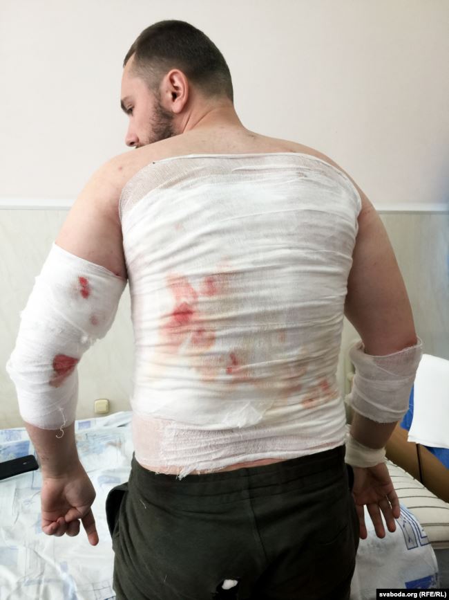В Беларуси пострадавшие от протестов рассказали об ужасах происходящего: фото 18+