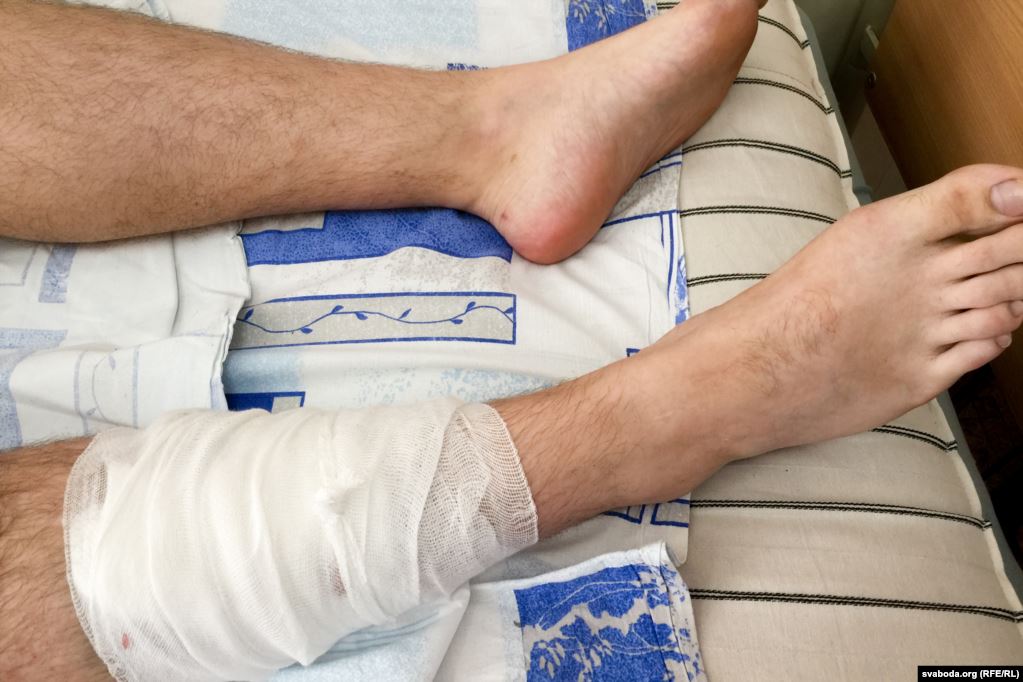 В Беларуси пострадавшие от протестов рассказали об ужасах происходящего: фото 18+