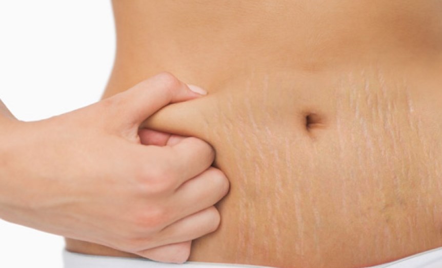 Як позбутися від розтяжок і запобігти їх появі