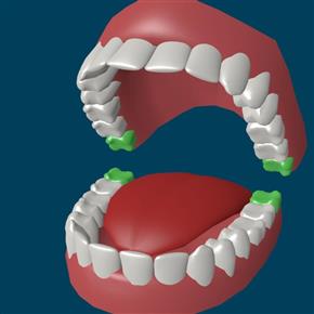 Що може бути, якщо не видаляти зуби мудрості?