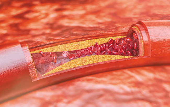 Тревожные симптомы: что нужно знать о инфаркте и инсульте