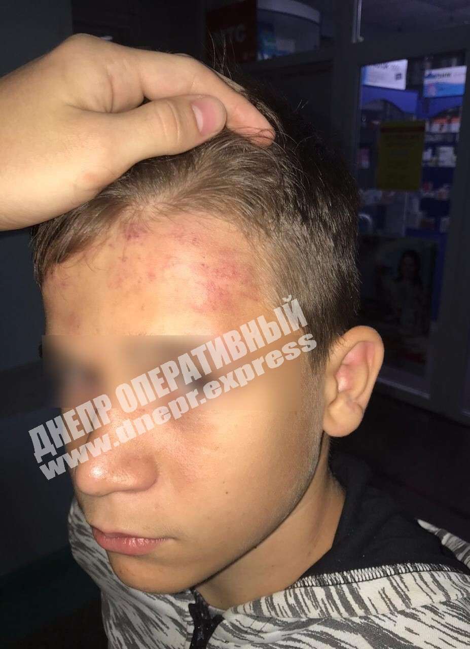 Душили и били по голове: под Днепром ромы напали на 12-летнего ребенка