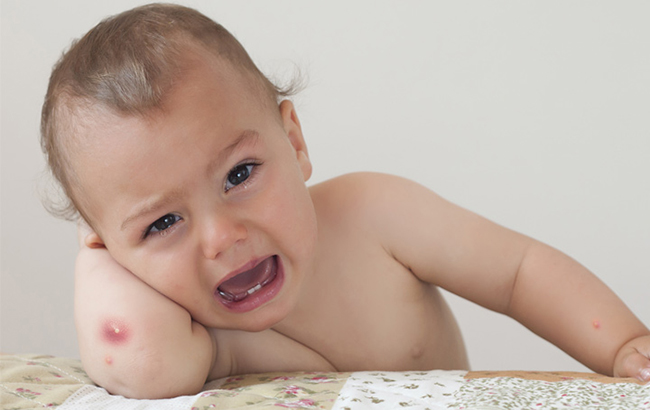 Вимагає тривалого лікування: Комаровський розповів про небезпечну інфекцію шкіри