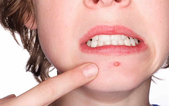 Вимагає тривалого лікування: Комаровський розповів про небезпечну інфекцію шкіри