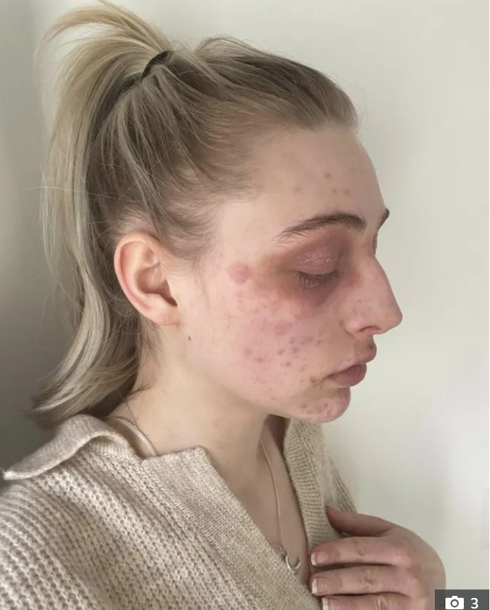 Дівчина потрапила до лікарні із зовнішністю "жертви чуми" через популярний засіб для вій (фото)