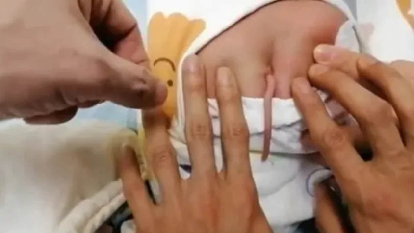 Лікарі показали немовля, яке народилося із 10-сантиметровим хвостом (фото і відео)