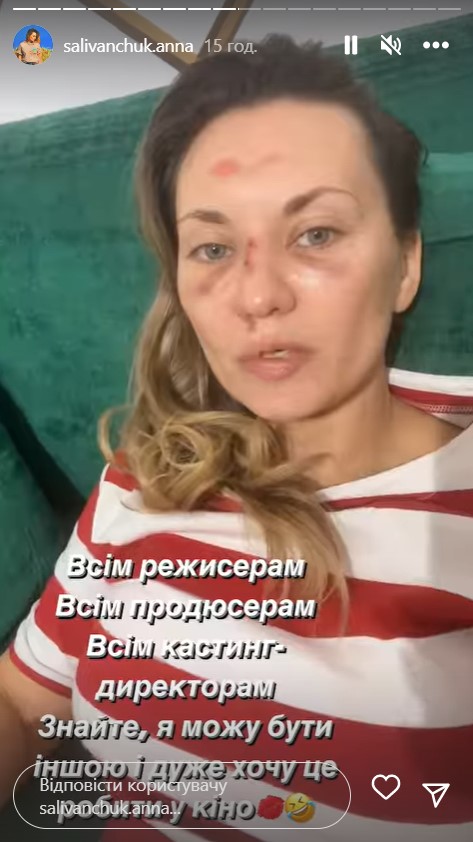 Зірка &quot;Квартала 95&quot; Саліванчук жахнула фото після перелому носа і струсу мозку