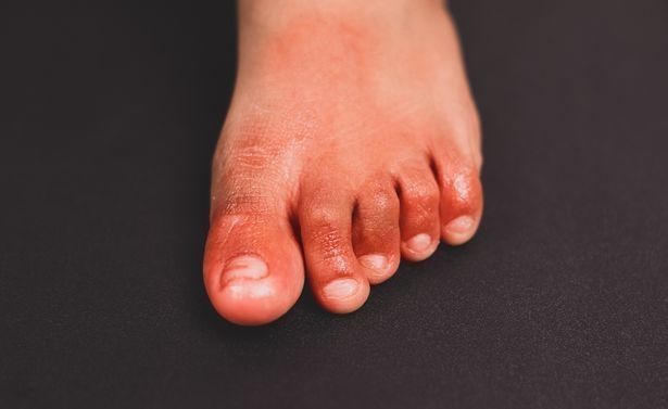 Вчені виявили новий симптом COVID, який нагадує обмороження ніг (фото)
