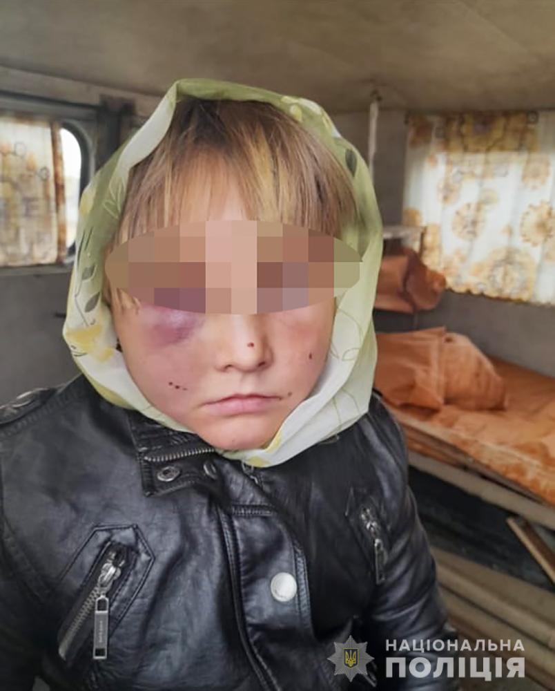 В Житомире отчим зверски избил 8-летнюю дочь: мать девочки накануне попала в больницу
