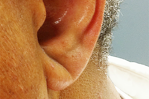 "Знак" на вухах може попередити про серцевий напад: як він виглядає