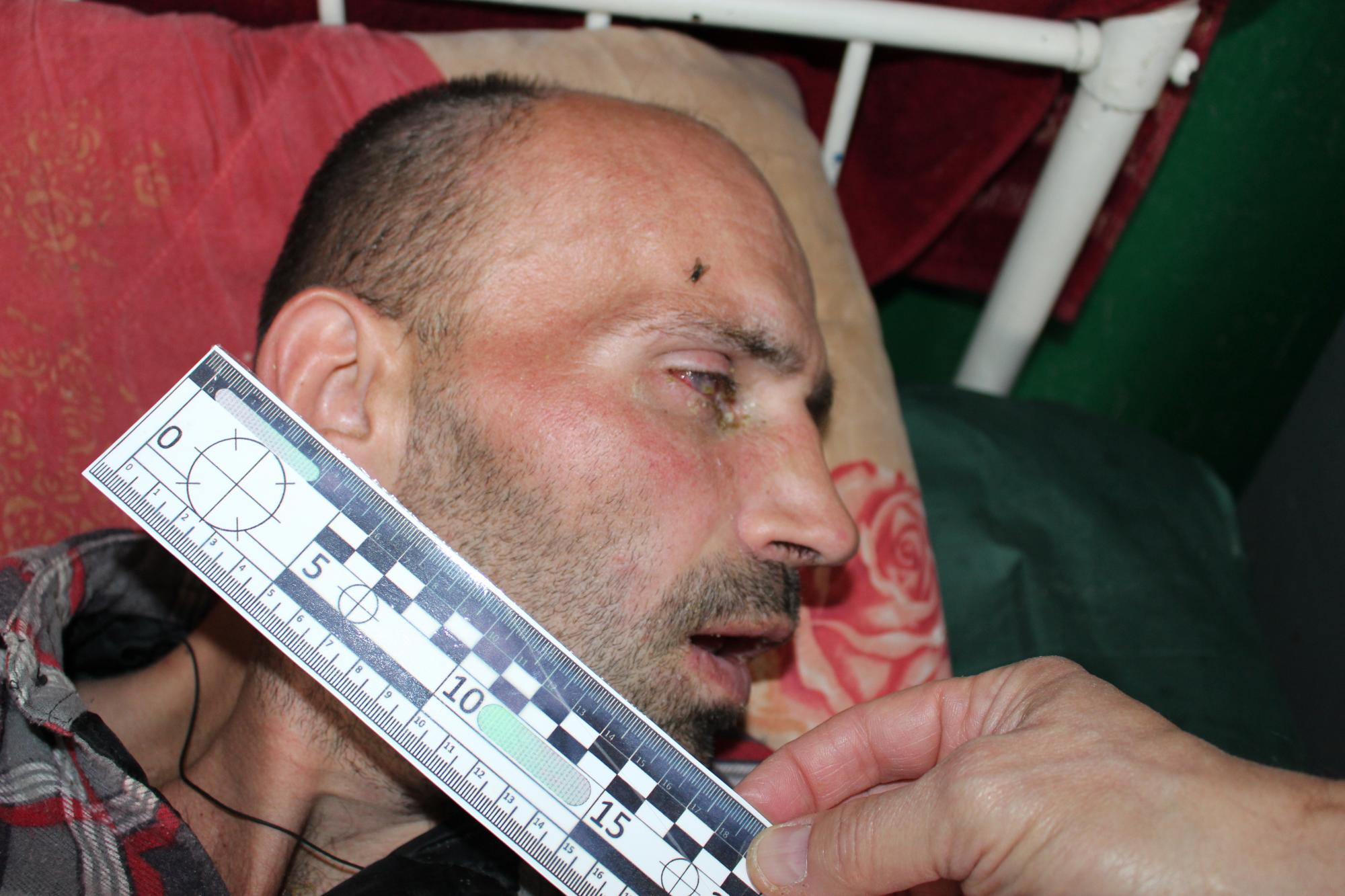 Українця з вм’ятиною у скроні лікують від бронхіту. Шокуючі кадри з лікарні, яку в народі називають 
