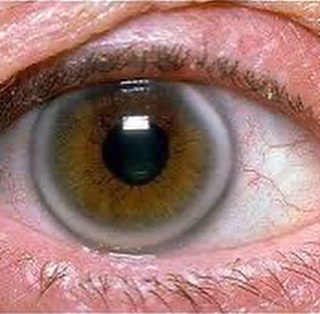 Як по очах розпізнати підвищений рівень холестерину і хто у групі ризику