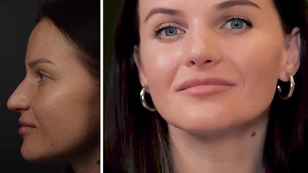 Скільки коштує ринопластика і зменшення грудей: Аліна Доротюк назвала суму