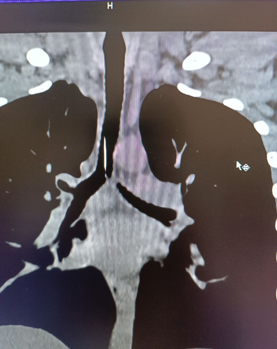 Застрягла прямо у трахеї: в Одеській області підліток випадково вдихнув шпильку