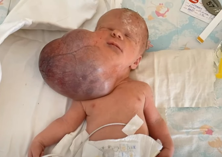 Была вдвое больше головы: в Украине врачи впервые удалили гигантскую опухоль у младенца