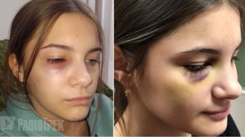 13-річний школяр з особливою жорстокістю побив дівчинку: на її обличчя боляче дивитися