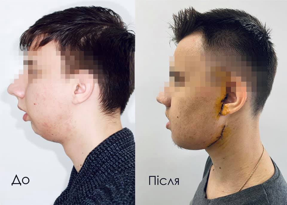 Украинские врачи заново собрали лицо молодому парню: фото до и после