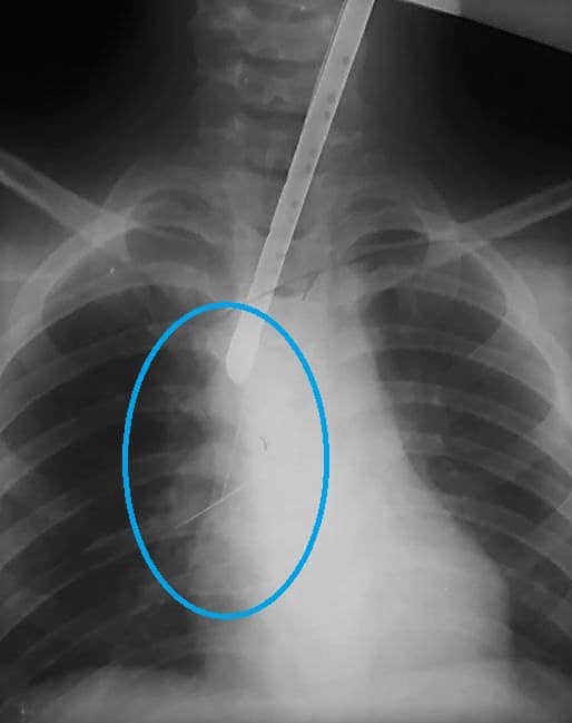 У Дніпрі дитина проковтнула булавку: лікарі врятували незвичайним способом (фото)