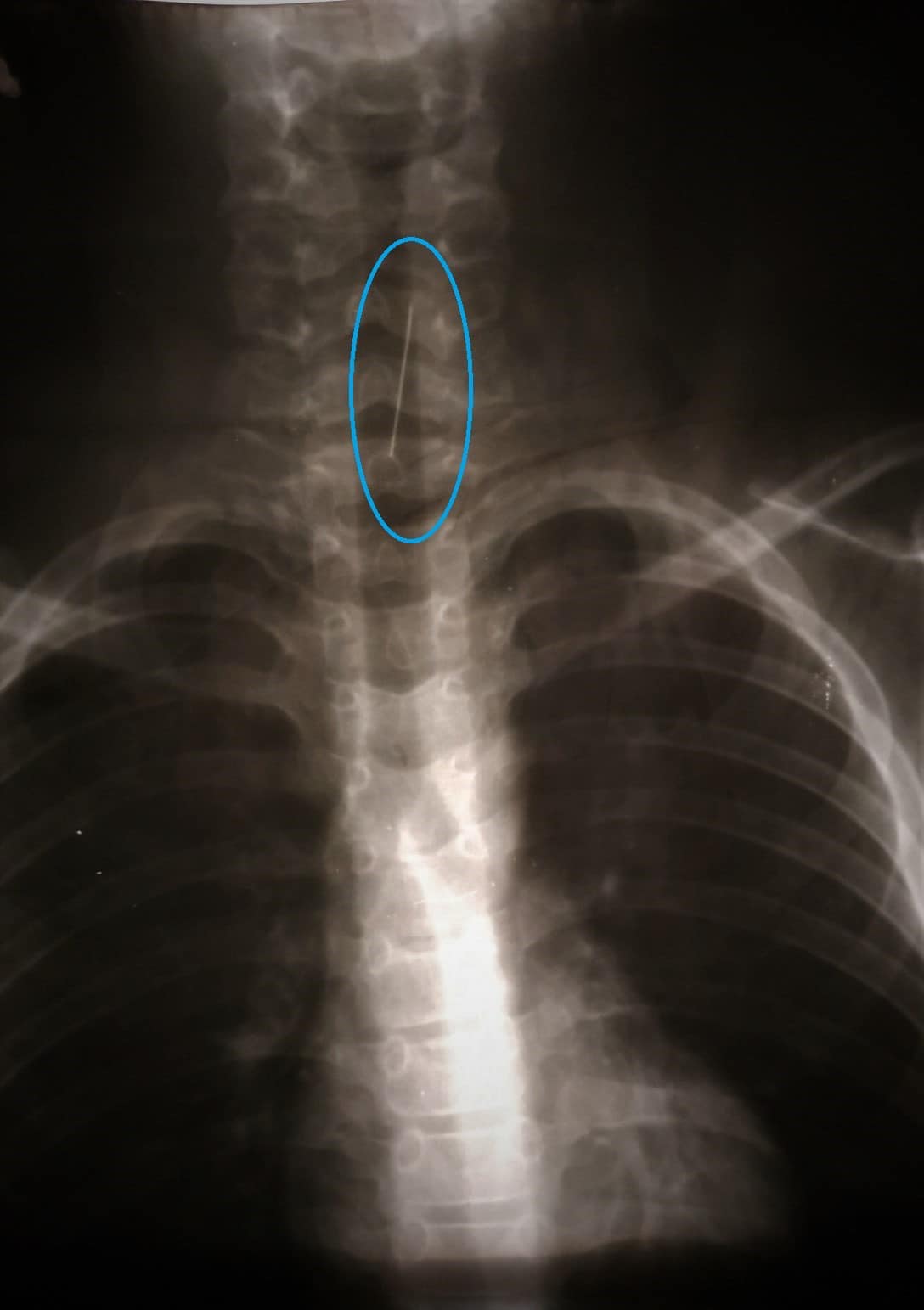 У Дніпрі дитина проковтнула булавку: лікарі врятували незвичайним способом (фото)