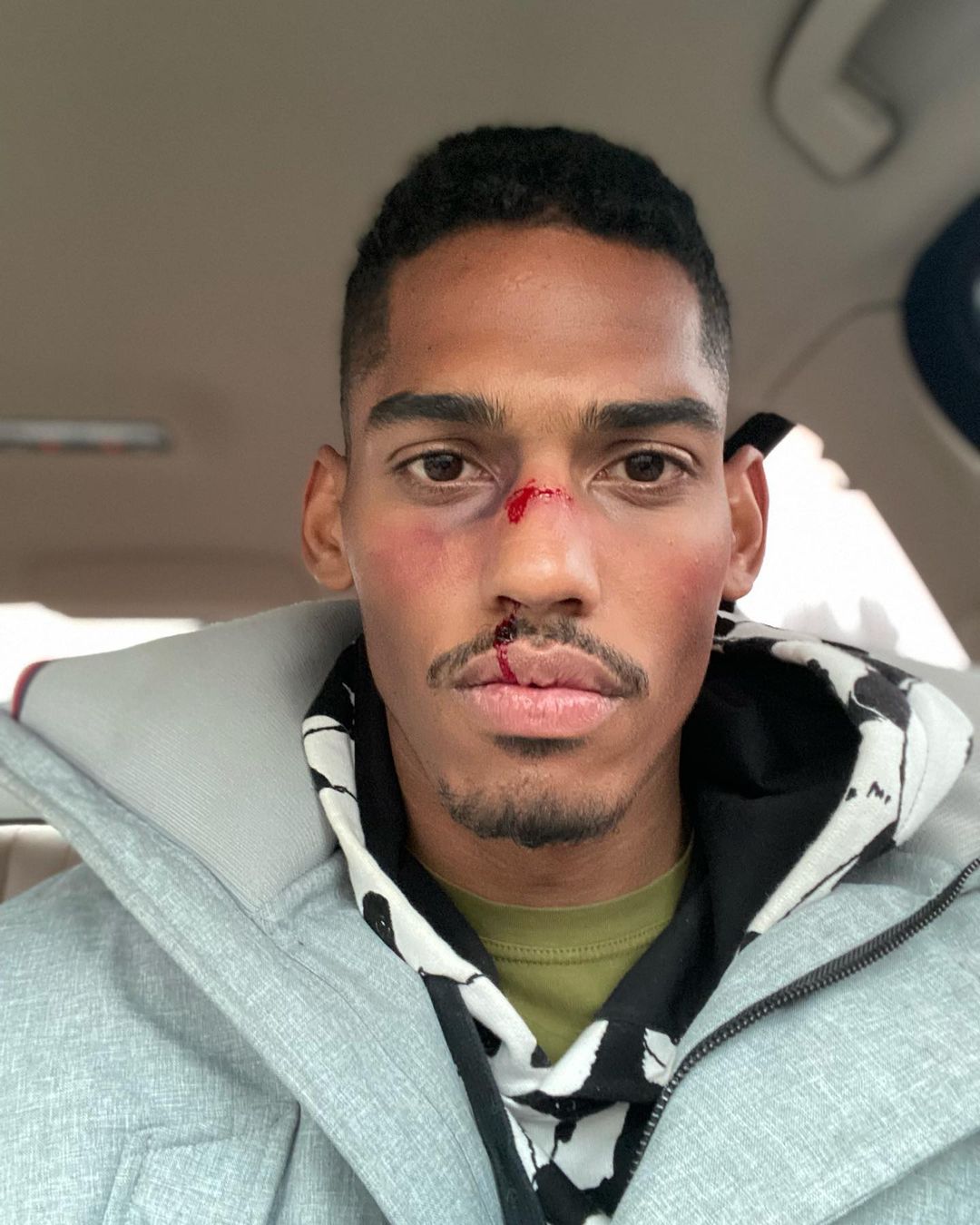 "Бывает и такое": танцор Поляковой показал окровавленное лицо