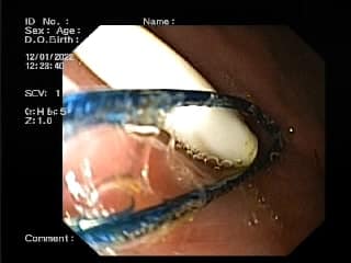 В Днепре ребенок съел палочку от Chupa Chups: была в теле 10 дней (фото)