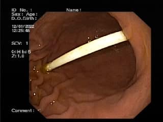 В Днепре ребенок съел палочку от Chupa Chups: была в теле 10 дней (фото)
