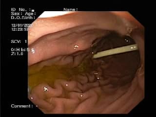 В Днепре ребенок съел палочку от Chupa Chups: была в теле 10 дней (фото)