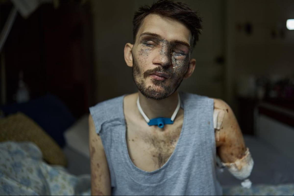 Потерял руки, зрение и отчасти слух. Жена раненого воина растрогала до слез историей своего мужа