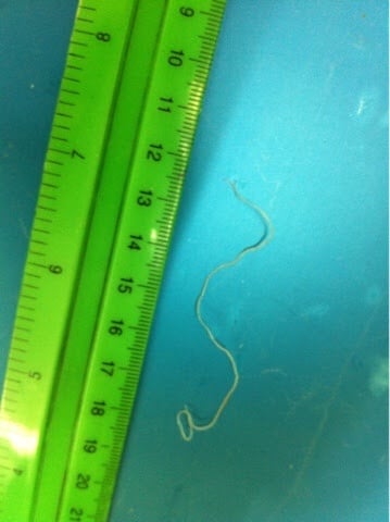 Во Львове из глаза ребенка достали 10-сантиметрового гельминта: как он туда попал (фото)