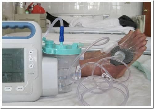 Сотни раненых: волонтеры просят помощи на покупку аппаратов ВАК