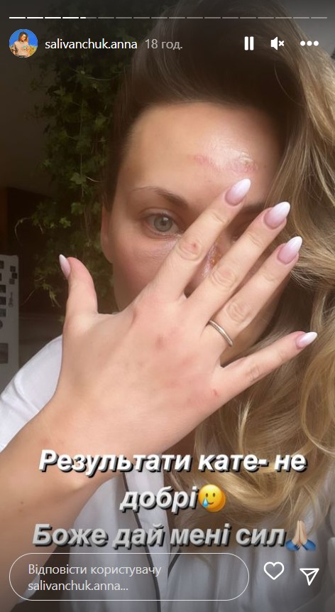 Зірка &quot;Квартала 95&quot; Саліванчук жахнула фото після перелому носа і струсу мозку