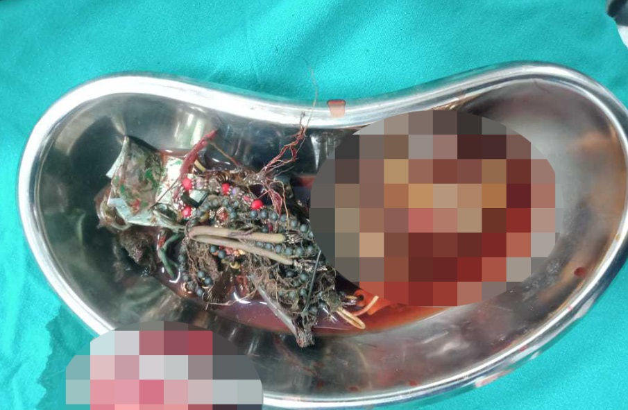 Чоловік потрапив до лікарні з болем у животі: лікарі витягли з його шлунка 60 предметів (фото)